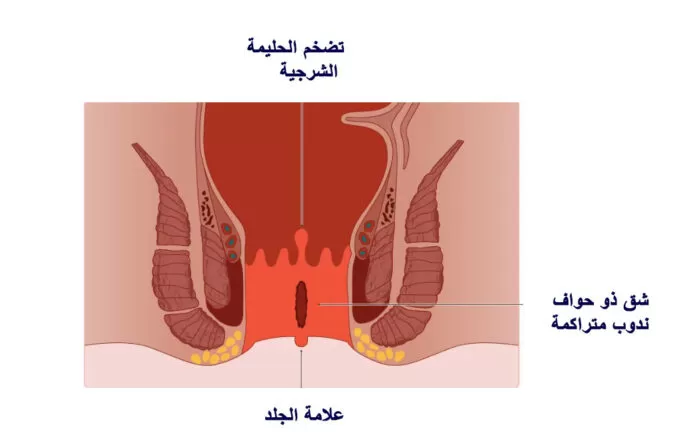 رسم الشق الشرجي