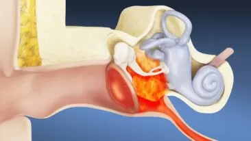 كل ما يجب أن تعرفه عن التهابات الأذن لدى البالغين