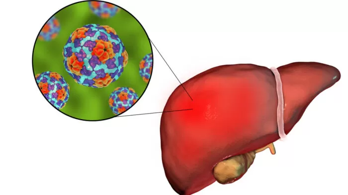 التهاب الكبد أ