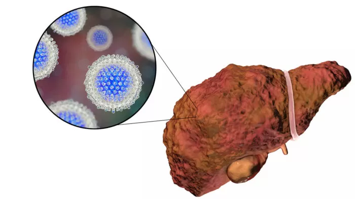 التهاب الكبد الوبائي سي