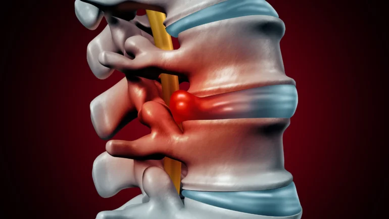 الانزلاق الغضروفي  أو فتق القرص الفقري